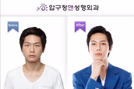 Mũi cao, mắt to, môi mọng hơn sau phẫu thuật