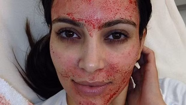 Bơm máu căng da mặt: 1500 USD/lần. Mặt nạ ma cà rồng là một biến tấu của kiểu nâng mặt trong đó người ta dùng máu để làm đầy da, thay vì tiêm các chất độn nguy hiểm khác. Phương pháp này dựa trên việc sử dụng các yếu tố tăng trưởng được tìm thấy trong máu để kích thích sản sinh collagen và làm trẻ hóa làn da. Các bác sĩ phẫu thuật cũng dùng phương pháp tương tự để tái tạo các mô nằm ở các khớp bị hư tổn.