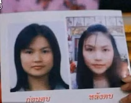 Thực tế có rất nhiều cô gái trẻ Thái Lan bỏ ra hàng trăm nghìn USD để tham gia các khóa học vỗ mặt, vỗ ngực. Theo nhiều nguồn tin, có những cô gái trẻ chỉ cần thực hiện 4 lần vỗ mặt đã có cằm V-line cực chuẩn giống như độn cằm. Tuy nhiên phương pháp này dường như khá hão huyền và đặc biệt là chi phí không hề rẻ.