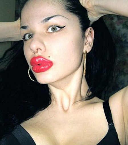 Nghiện bơm môi silicone. Điển hình là trường hợp của Christina Ryan, một cô gái 22 tuổi người Nga. Ngay từ tuổi thiếu niên, Christina đã mê mẩn vành môi căng mọng, đầy đặn. Cô luôn cho rằng, đôi môi mỏng dính của mình không hề gợi cảm và có sức cuốn hút. Tới tuổi trưởng thành, Christina thường xuyên lui tới các trung tâm thẩm mỹ để cấy ghép silicone lên môi. Sở thích đó giờ đã biến thành chứng nghiện thẩm mỹ.