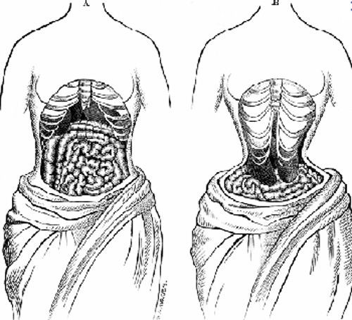 Phẫu thuật loại bỏ xương sườn. Việc loại bỏ xương sườn số 11 và 12 sẽ giúp bạn có một vòng eo nhỏ nhắn và vóc dáng đồng hồ cát hoặc chữ S ưng ý. Tuy nhiên, chức năng của xương sườn là bảo vệ các cơ quan nội tang, giúp chúng không bị tổn thương nên việc loại bỏ chúng sẽ gây ra những hậu quả nghiêm trọng.