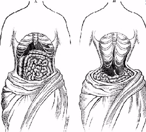 Phẫu thuật loại bỏ xương sườn. Việc loại bỏ xương sườn số 11 và 12 sẽ giúp bạn có một vòng eo nhỏ nhắn và vóc dáng đồng hồ cát hoặc chữ S ưng ý. Tuy nhiên, chức năng của xương sườn là bảo vệ các cơ quan nội tang, giúp chúng không bị tổn thương nên việc loại bỏ chúng sẽ gây ra những hậu quả nghiêm trọng.