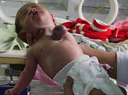 Không chỉ ở nước ngoài, trường hợp bé sơ sinh có trái tim ngoài lồng ngực cũng từng xuất hiện tại Việt Nam, hồi tháng 3/2007, bệnh viện Đa khoa Quảng Ngãi đã thực hiện ca mổ đẻ cho chị Lê Thị Đào (SN 1974, huyện Tư Nghĩa, Quảng Ngãi). Khi lấy đứa trẻ ra khỏi bụng mẹ, các bác sĩ phát hiện cháu bé có trái tim nằm ngoài lồng ngực. Trừ trái tim nằm ngoài lồng ngực, các bộ phận còn lại của cháu đều bình thường.