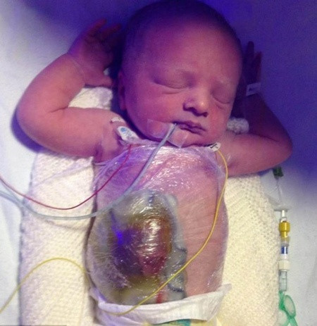 Bé Joshua O’Callaghan, ở Widnes, Merseyside, Anh, được sinh vào tháng 11-2013 ngoái, trong tình trạng ruột lòi ra khỏi bụng.