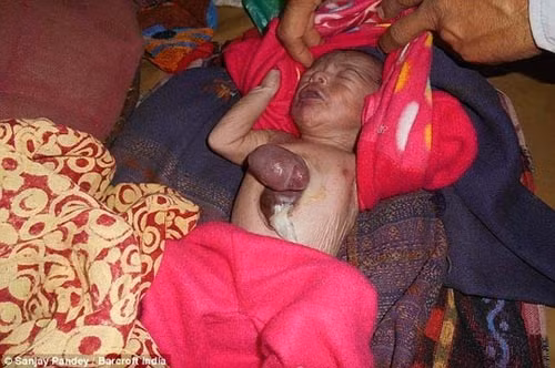 Theo thống kê, tỉ lệ mắc bệnh chỉ 8/1 triệu trẻ sơ sinh, trong đó 90% trẻ gặp phải trường hợp này sẽ chết non hoặc 3 ngày sau khi sinh ra. Kỳ diệu là bé trai này lại có thể sống được đến 6 ngày nhưng nếu muốn kéo dài thời gian sống, em bé cần phải được phẫu thuật sớm.