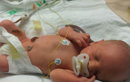 Joshua được chuẩn đoán mặc bệnh Gastroschisis, hay còn gọi là nứt thành bụng, có tỉ lệ 1/2000 đứa trẻ được sinh ra. Dị tật này sẽ làm đường ruột của cậu bị mắc kẹt trong dây rốn. Các bác sĩ đã rất vất vả để phẫu thuật đưa ruột vào bên trong cơ thể khi cậu mới 2 ngày tuổi.