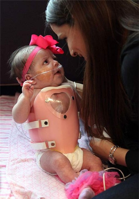 Bé Audrina mắc phải căn bệnh lạc vị tim ổ bụng, một trường hợp hiếm gặp khiến tim trẻ sơ sinh nằm ngoài lồng ngực.