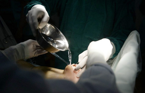 Sau đó, tiến hành lọc rửa và hút dung dịch ra khỏi cơ thể.