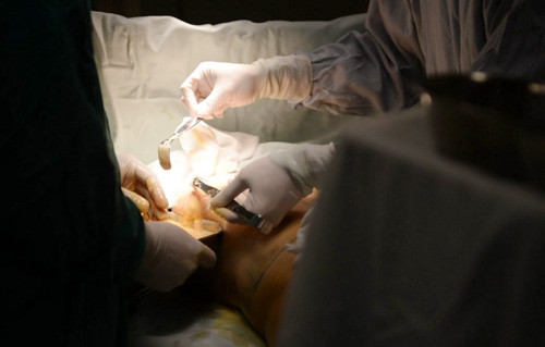 Bác sỹ gắp những mảnh chất độn ra khỏi cơ thể Tian Hui.