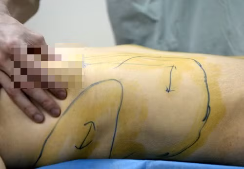 Các bác sĩ cho biết, dung dịch "chạy" trong cơ thể cô chính là chất polyacrylamide. Chất này được tiêm vào ngực cô Tian là polyacrylamide hydrophilic - một chất đã bị cấm ở Trung Quốc từ năm 2006. Tình trạng của cô phải được lập tức phẫu thuật ngay, nếu không sẽ nguy hiểm đến tính mạng.