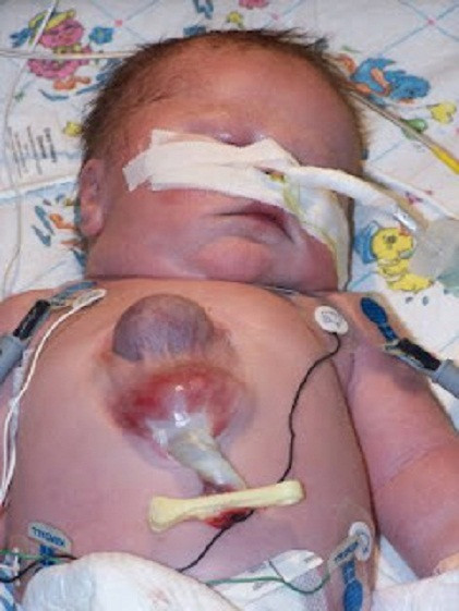 Tháng 2/2012, bé Ryan Marquiss (ở Pennsylvania, Mỹ) được sinh ra với trái tim nằm bên ngoài của cơ thể. Các bác sĩ đã không nghĩ rằng cậu bé có thể sống sót. Đây là một trường hợp cực kỳ hiếm gặp.