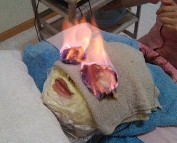 Các nhân viên trong thẩm mỹ viện sẽ bôi một dung dịch gọi là “thần dược” lên làn da sau đó dùng một chiếc khăn đã tẩm cồn, đốt lửa lên khu vực đang được chăm sóc đó.