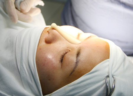 Nghiện sửa mũi. Nhiều BS thẩm mỹ cho biết, mũi là một trong những bộ phận được chị em quan tâm nhất trong khuôn mặt, chính vì thế mà mũi được chỉnh sửa nhiều nhất. Có những chị em phải sửa mũi đến 5 -6 lần do không ưng ý với khuôn mặt hoặc do biến chứng sau dao kéo.