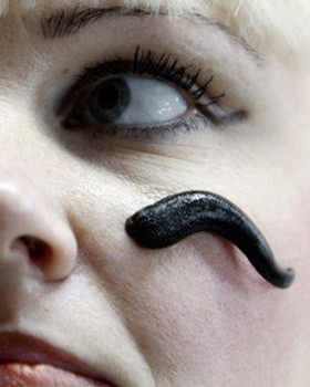 Demi cho biết: "Đỉa tiết ra một loại enzyme có tác dụng lọc máu. Sau những lần trị liệu bằng cách này, tôi cảm thấy rất dễ chịu".