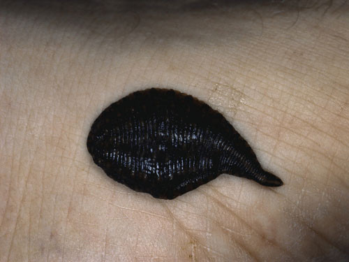 Quá trình trị liệu sẽ kéo dài trong khoảng 40 phút. Mỗi một con đỉa khi hút đủ máu sẽ to gấp 4 lần so với kích thước thực của chúng.