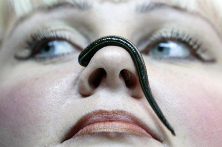 Hiện nay, một số thẩm mỹ viện ở nhiều nước trên thế giới, thậm chí cả ở Việt Nam đã thực hiện phương pháp này. Tuy nhiên, do chuyên môn còn khá yếu kém vì chưa được đào tạo bài bản, chất lượng của các dịch vụ này vẫn chưa hề được kiểm chứng.