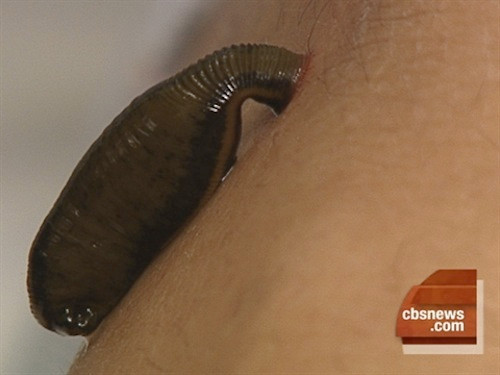 Trích máu được biết đến là một phương pháp trị liệu nhằm chữa trị hoặc ngăn ngừa bệnh tật của người phương Tây từ xa xưa.