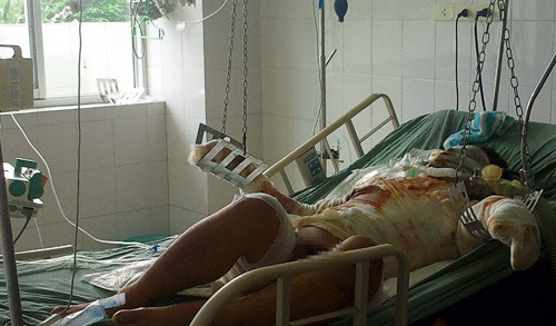 Bệnh nhân Hải tại Viện bỏng Quốc gia.