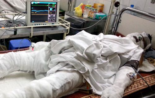 Công nhân Doãn Văn Hùng (43 tuổi, ở Phúc Thọ, Hà Nội) đang được điều trị tại BV Xanh -Pôn.