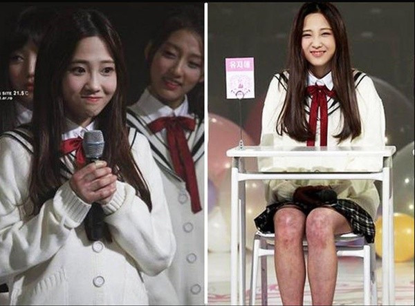  Yoo Ji Ae (Lovelyz): Thành viên nhóm Lovelyz từng bị bàn tán trên các trang mạng khi để lộ đôi chân khá xấu trong buổi trình diễn. Chân Ji Ae bị sưng tấy, xuất hiện nhiều vết bầm tím cũng như mạch máu khắp vùng đầu gối và bắp chân.