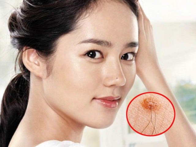 Đây là nốt ruồi sinh lợi và vô hại. Vì vậy, những người có nốt ruồi như vậy thường là người giàu sang phú quý. 