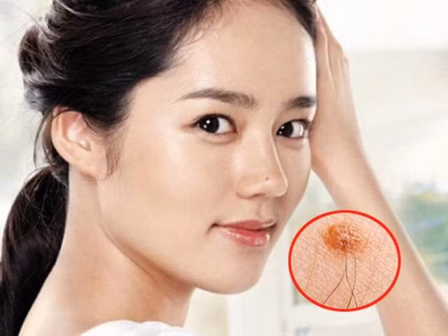 Đây là nốt ruồi sinh lợi và vô hại. Vì vậy, những người có nốt ruồi như vậy thường là người giàu sang phú quý. 