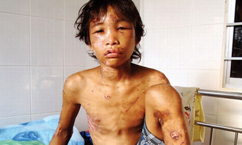 Hào Anh khi mới được giải cứu khỏi nhà của hai vợ chồng chủ đầm tôm với thương tích đầy mình.