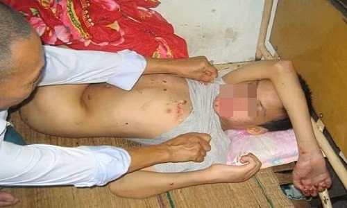 Cháu Nguyễn Anh Tú được phát hiện bị hành hạ dã man. Cháu đã được đưa đi bệnh viện đa khoa tỉnh Nghệ An cấp cứu. Theo các bác sỹ tại Khoa thần kinh cột sống, nơi cháu Tú đang nằm điều trị, bệnh nhân nhập viện trong tình trạng thần kinh hoảng loạn, bị xây xát ở vùng mặt, ngực, tay, chân. Ngoài ra vùng hậu môn bị loét, dương vật bị sưng nề, bầm tím. Bước đầu kết luận những vết thương đó có thể do bị đối tượng Sơn đánh, bắt ép quan hệ tình dục.