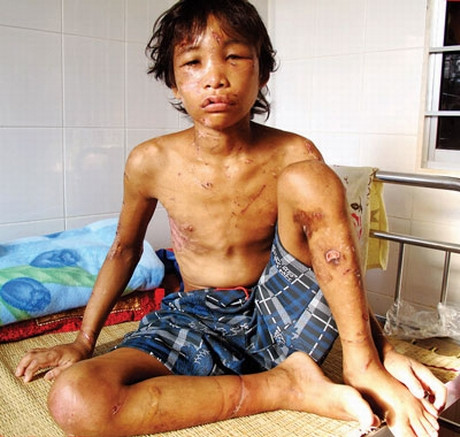 Hào Anh thương tích đầy mình khi mới được giải cứu từ ngôi nhà của vợ chồng chủ trại nuôi tôm ở Cà Mau.