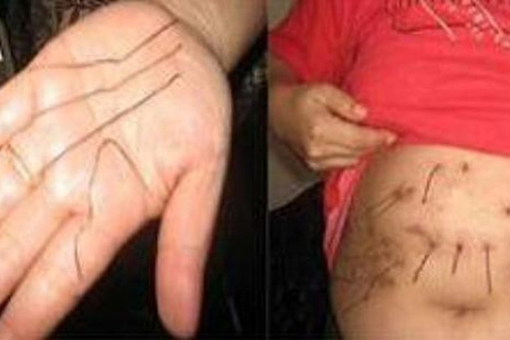 4. Người phụ nữ mọc ra kim loại: Tại ngôi làng Sangatta thuộc tỉnh Đông Kalimantan của đất nước Indonesia có một phụ nữ tên Noorsyaidah làm nghề giáo viên mầm non. Năm 1991, cơ thể của Noorsyaidah bắt đầu xuất hiện những dây kim loại từ bên trong chui ra khỏi ngực và bụng. Sau một tuần những sợi dây kim loại này bỗng rụng đi.