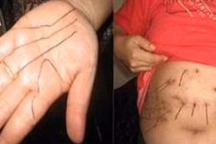 4. Người phụ nữ mọc ra kim loại: Tại ngôi làng Sangatta thuộc tỉnh Đông Kalimantan của đất nước Indonesia có một phụ nữ tên Noorsyaidah làm nghề giáo viên mầm non. Năm 1991, cơ thể của Noorsyaidah bắt đầu xuất hiện những dây kim loại từ bên trong chui ra khỏi ngực và bụng. Sau một tuần những sợi dây kim loại này bỗng rụng đi.