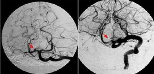 Huyết khối gây tắc mạch làm thiếu máu nuôi vùng não.