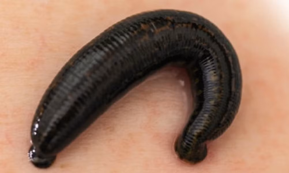 Y học dùng đỉa để chống bệnh máu đông, hút các ổ máu tụ, máu bầm, áp xe mà không cần mổ.