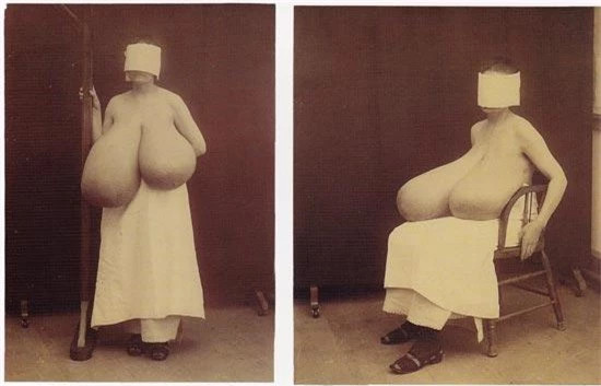 4. Bộ ngực khổng lồ: Người phụ nữ kém may mắn này bị mắc chứng phì đại ở cả hai bên vú. Điều ngạc nhiên là bà đã sống sót qua các cuộc phẫu thuật để loại bỏ hoàn toàn phần thịt thừa. Trước khi phẫu thuật, phần vú trái có trọng lượng 17 kg và bên phải nặng 40 kg.