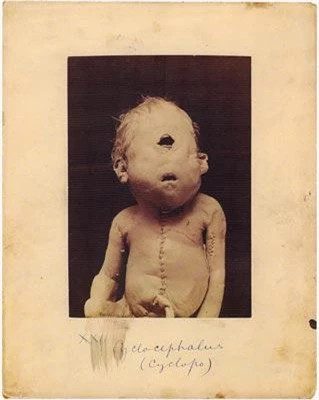 1. Người một mắt: Cyclopia (Một mắt) là một chứng khuyết tật bẩm sinh cực kỳ hiếm, khi đó cơ thể không thể tách đúng hai ổ mắt ra 2 bên như bình thường mà sáp liền vào nhau thành một. Phần lớn trẻ sơ sinh mắc bệnh này đều chết ngay khi sinh nhưng nếu có sống sót thì thường không hơn một vài giờ.