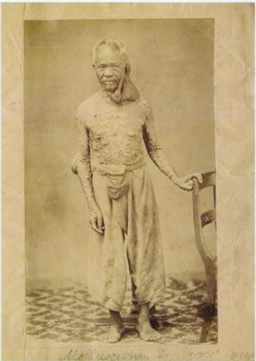 6. Người "bong bóng": Người đàn ông này bị bệnh Von Recklinhausen (còn gọi là chứng U sợi thần kinh -Neurofibromatosis). Đây là một chứng rối loạn di truyền khiến các dây thần kinh của bạn phát triển khối các u. Nếu bố hoặc mẹ mắc bệnh này thì có đến 50% tỉ lệ con cái sinh ra cũng sẽ bị.