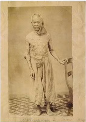 6. Người "bong bóng": Người đàn ông này bị bệnh Von Recklinhausen (còn gọi là chứng U sợi thần kinh -Neurofibromatosis). Đây là một chứng rối loạn di truyền khiến các dây thần kinh của bạn phát triển khối các u. Nếu bố hoặc mẹ mắc bệnh này thì có đến 50% tỉ lệ con cái sinh ra cũng sẽ bị.