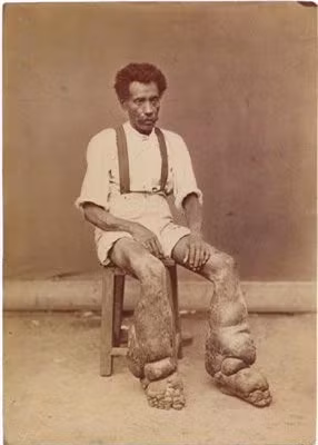 5. Người chân voi: Người đàn ông ở trên bị mắc bệnh chân voi. Ông ta từng cầu xin được cắt cụt chân mình vì cảm thấy rất đau khổ nhưng đã được phẫu thuật loại bỏ nhiều phần mô thừa thay vì cắt cụt. Tuy nhiên thật không may khi ông đã qua đời chỉ 5 tháng sau đó.