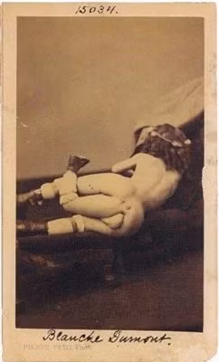 3. Người 3 chân: Đây là bức ảnh hiếm hoi chụp từ phía sau của bà Blanche Dumas. Có thể mọi người sẽ ít biết về trường hợp này, bà Dumas sở hữu 3 chân, 2 bộ ngực, 2 âm đạo và hơn nữa, bà từng có mối quan hệ với người đàn ông quái dị Juan Baptista Dos Santos - người đàn ông cũng có 3 chân và 2 dương vật.