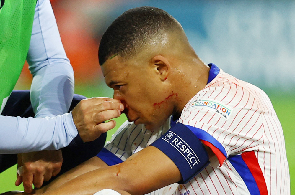 Mbappe bi gay mui, bo ngo kha nang ra san tran sau-Hinh-4