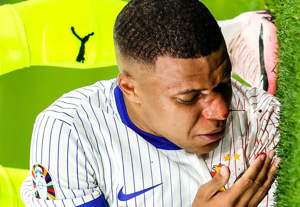 Mbappe bi gay mui, bo ngo kha nang ra san tran sau-Hinh-3