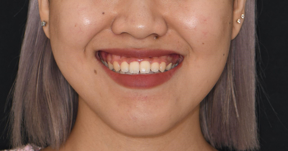  Khi mang nét tướng này, bạn mà cho ai vay tiền thì dễ dính nợ xấu khó đòi, mất cả tình lẫn tiền. Chính vì tính cả tin mà người cười lộ xỉ dễ hi sinh, hết lòng cho người khác.