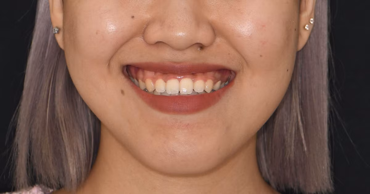  Khi mang nét tướng này, bạn mà cho ai vay tiền thì dễ dính nợ xấu khó đòi, mất cả tình lẫn tiền. Chính vì tính cả tin mà người cười lộ xỉ dễ hi sinh, hết lòng cho người khác.