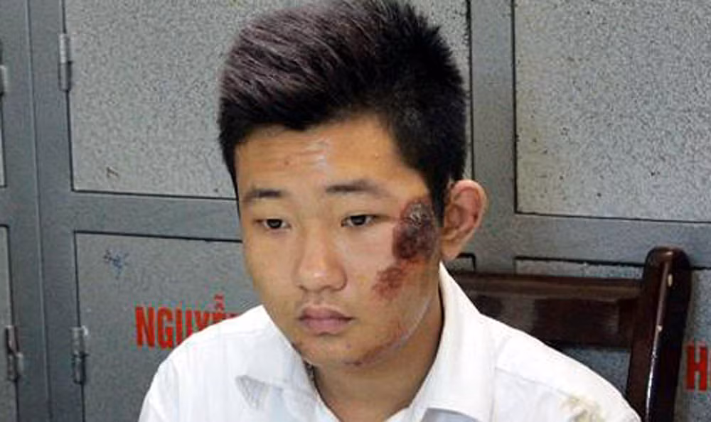 Đào Quang Khánh tại cơ quan điều tra. Mặt Khánh bị thương do tai nạn xe máy.