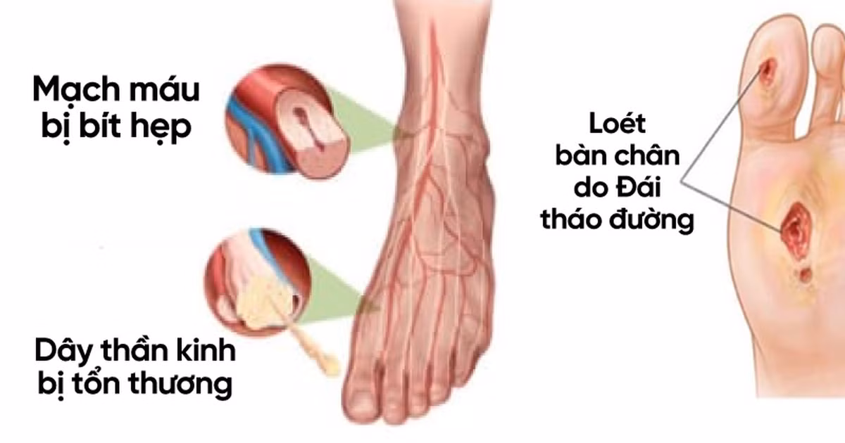 Loet ban chan nang vi 'buong bo' dieu tri dai thao duong-Hinh-2