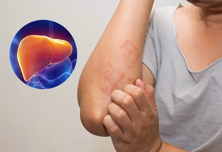 Dấu hiệu trên da cảnh báo gan nhiễm mỡ, cần đi khám ngay. Ảnh minh họa
