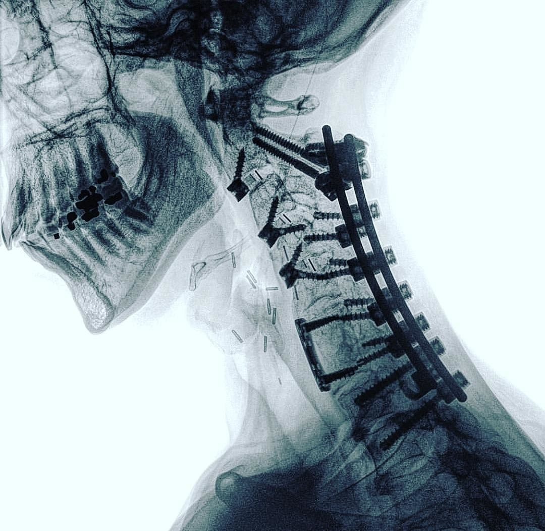 Đến năm 1897, tia X lần đầu tiên được sử dụng trong quân sự, trong cuộc Chiến tranh Balkan, để tìm các mảnh đạn và vị trí xương gãy bên trong cơ thể bệnh nhân.