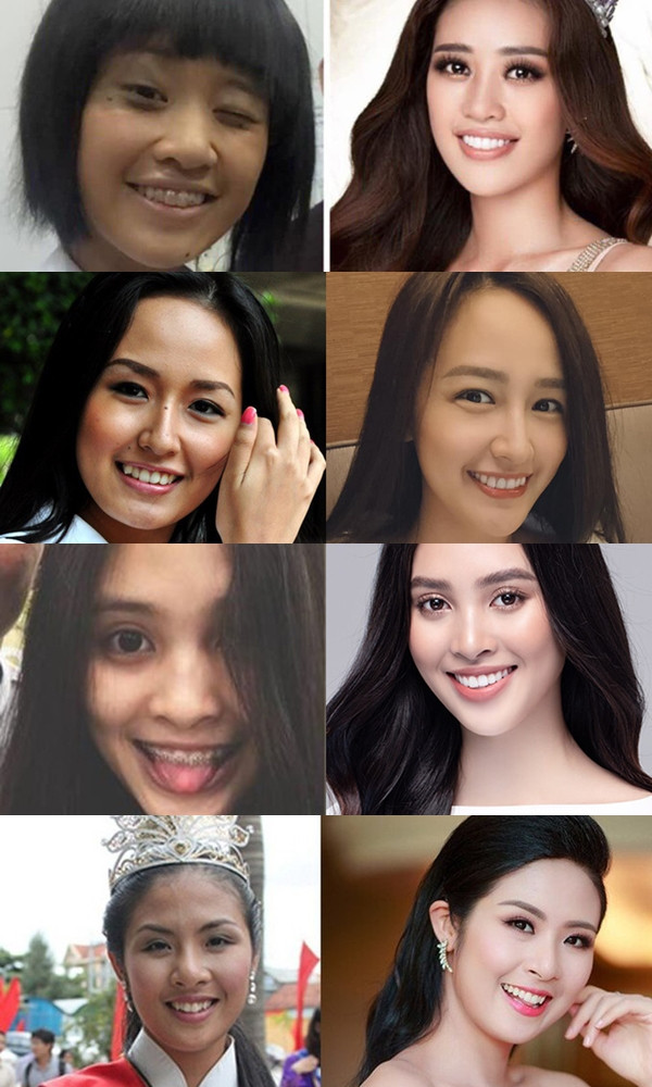 br/> Gần đây, hình ảnh các nàng hậu lột xác ngoại hình nhờ niềng răng lan truyền rộng rãi mạng xã hội. Sự thay đổi của dàn chân dài khiến nhiều người phải trầm trồ, trong đó có Mai Phương Thúy. Bị nhắc tên khá nhiều, mới đây Hoa hậu Việt Nam 2006 bất ngờ lên tiếng. Mai Phương Thúy cho biết cô chưa bao giờ niềng răng, chỉ từng thay răng do bị gãy.