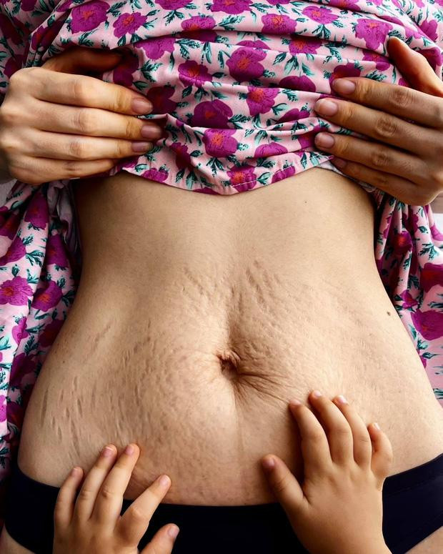 Cận vòng 2 thon gọn nhưng lại chằng chịt vết nứt da của Hoà Minzy, hội mẹ bỉm phải gật gù đồng cảm. Dù đã bôi đủ loại kem nhưng các vết rạn của Hoà Minzy vẫn còn khá rõ. 