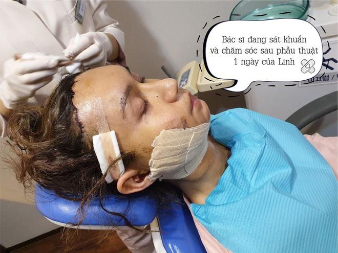 Lynk Lee không ngại chia sẻ hình ảnh còn vết dao mổ, gương mặt sưng tấy sau phẫu thuật.